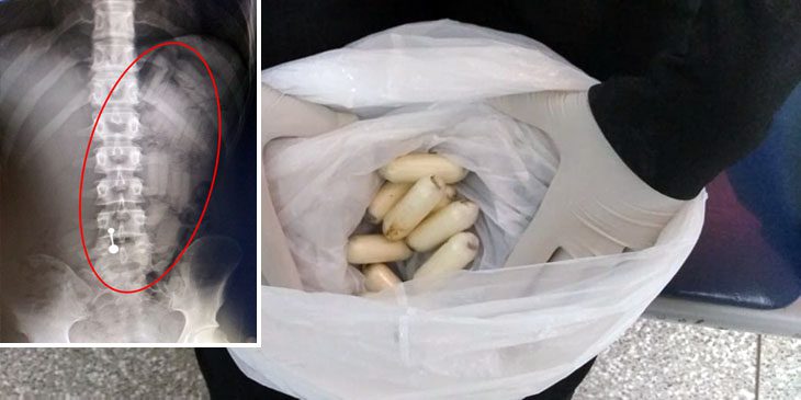 Jovem é presa pela PRF transportando 50 capsulas de cocaína no estomago