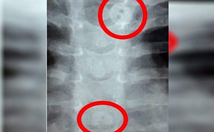 Criança vai parar no pronto-socorro após fazer raio-x vestida e médico achar que ela tinha engolido botões da camisa