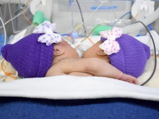 Após duas semanas de vida, gêmeas siamesas morrem na Santa Casa