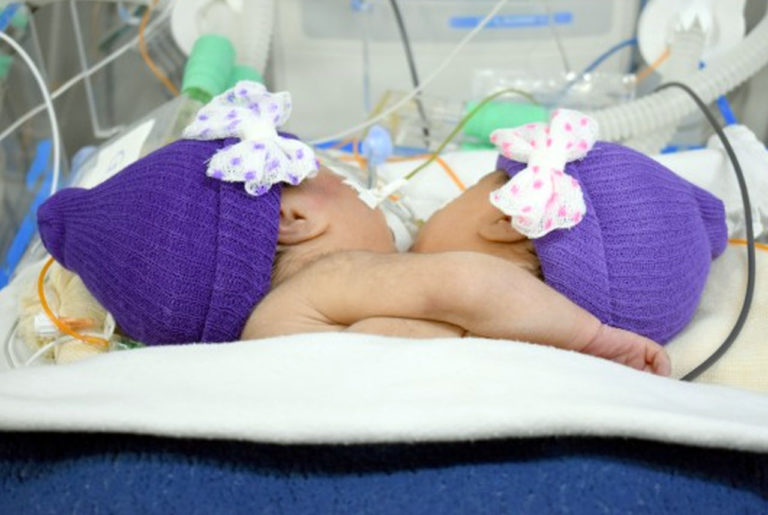 Ainda sem previsão de cirurgia, gêmeas siamesas continuam em estado grave