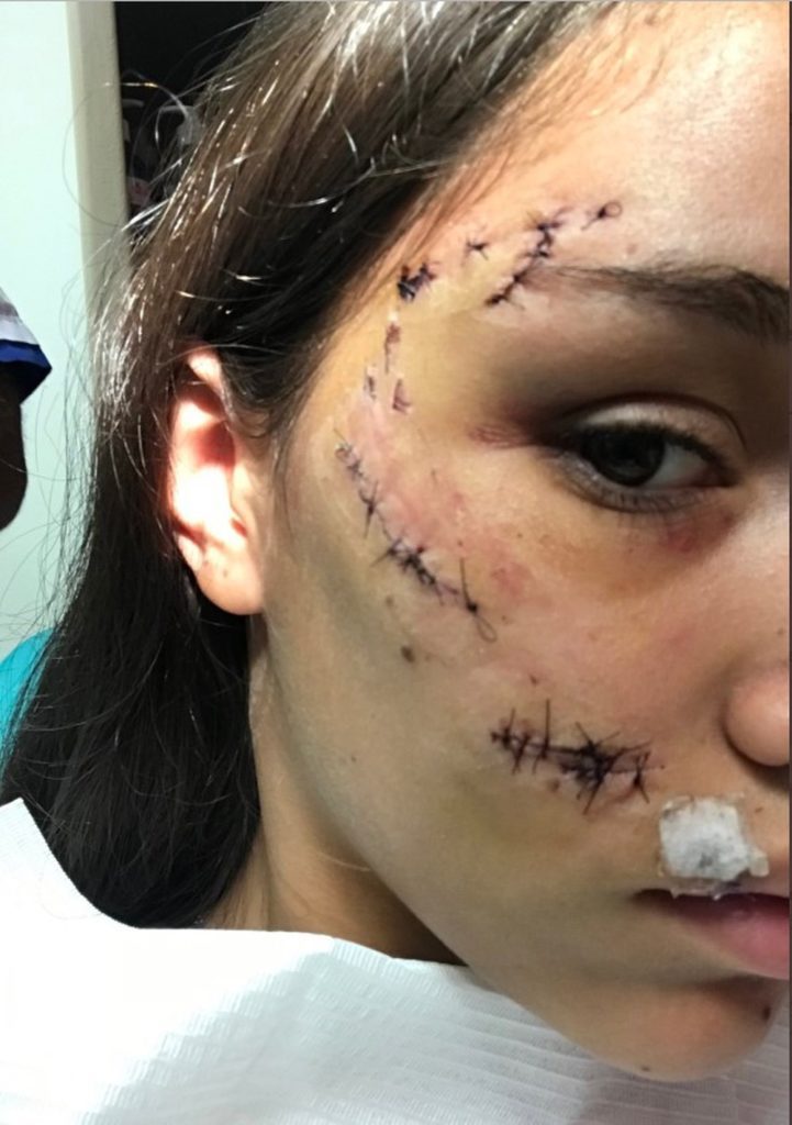Argentina tira foto com cachorro, toma mordida, leva pontos no rosto e publica imagens em rede social 5 mordida 04