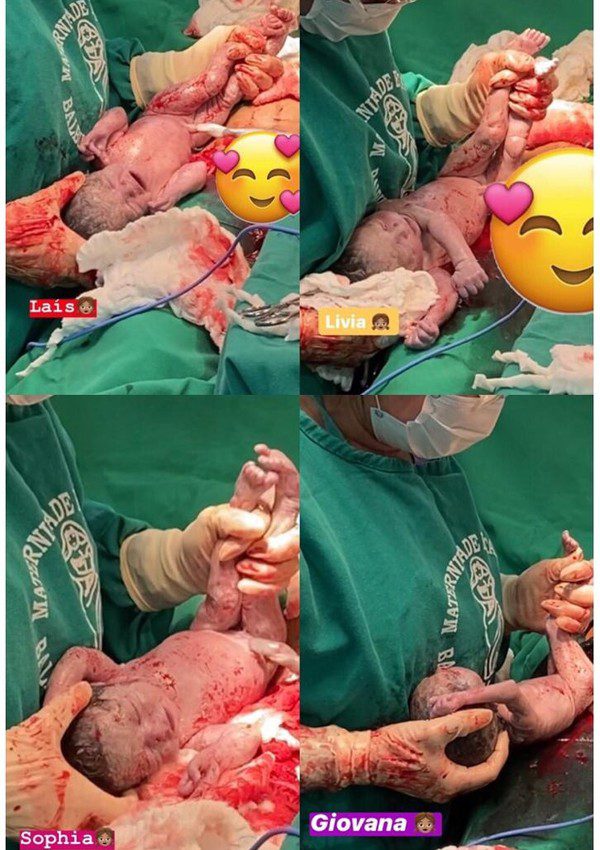 Mãe que esperava trigêmeas descobre quarta filha ‘surpresa’ na hora do parto em maternidade de Manaus
