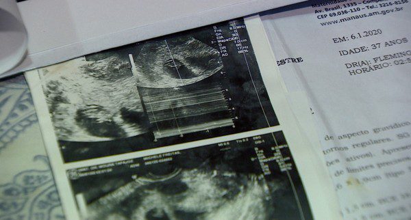 Mãe que esperava trigêmeas descobre quarta filha 'surpresa' na hora do parto em maternidade de Manaus 2 whatsapp image 2020 07 23 at 08.17.46