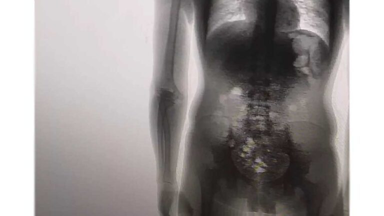 Preso é flagrado com 8 celulares, carregadores, cabos e chips dentro no corpo em MT