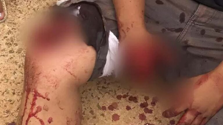 Adolescente perde dois dedos em explosão de fogos de artifício em Campo Grande