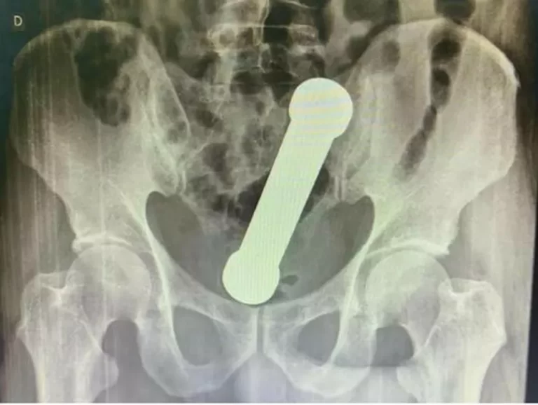 Homem que ficou com peso de academia de 2kg preso no reto é tema de estudo científico