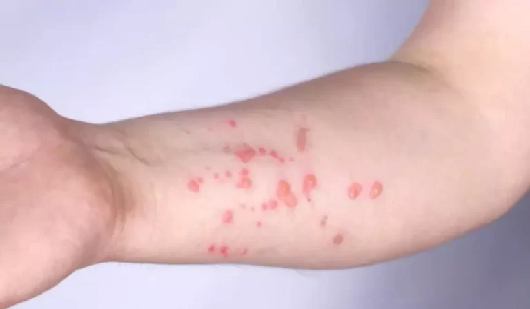 Três novos casos da Varíola dos Macacos são confirmados em MS