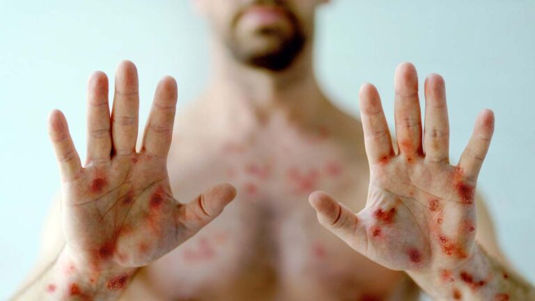 Mais sete casos da varíola dos macacos são confirmados pela SES em MS