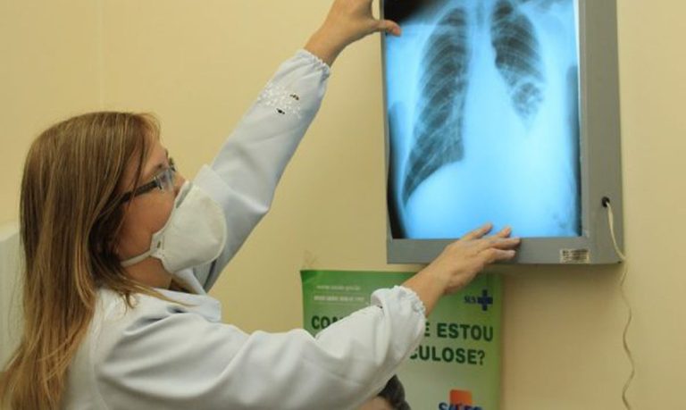 Conselho aprova novas diretrizes para tratamento da tuberculose no SUS´