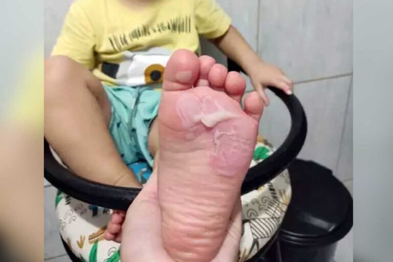 Escola é acusada de negligência após bebê ter pés queimados em Campo Grande