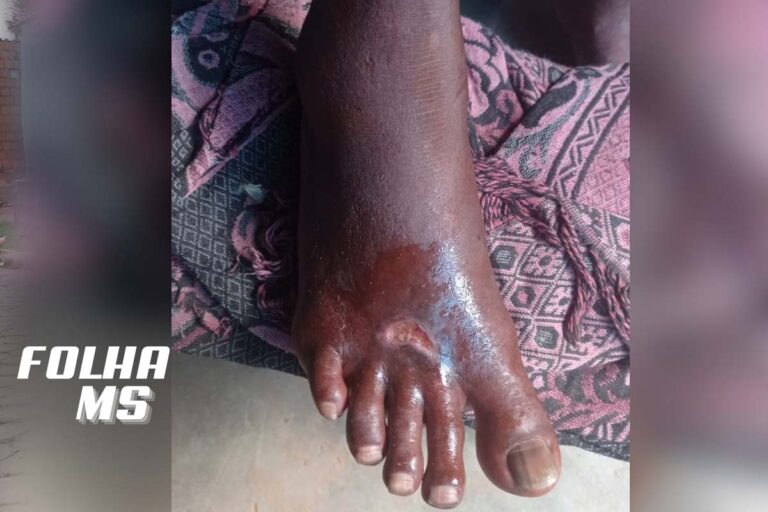 Com ferimento no pé, idoso é resgatado pelo Corpo de Bombeiros em aldeia no Pantanal