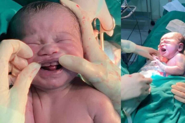 Bebê surpreende pais e médicos ao nascer com seis dentes em Campo Grande