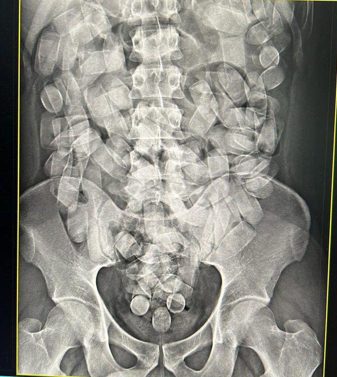 cocaína no Estomago