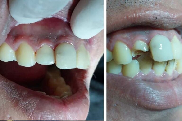 Ribeirinho de Porto Esperança recebe sorriso renovado em ação pioneira do Povo das Águas