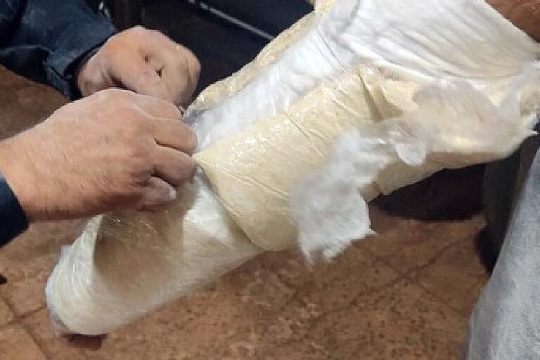 PRF prende homem que transportava cocaína escondido em braço engessado