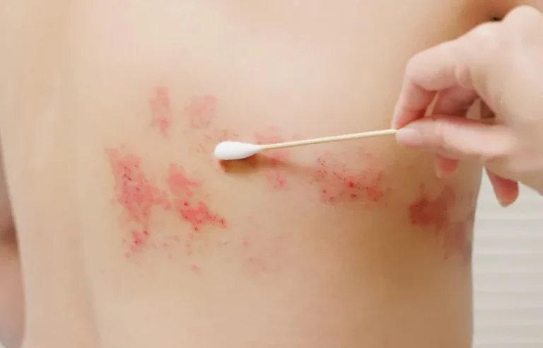 herpes-zoster