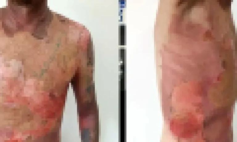 Mulher é presa após jogar água fervendo em vizinho após discussão