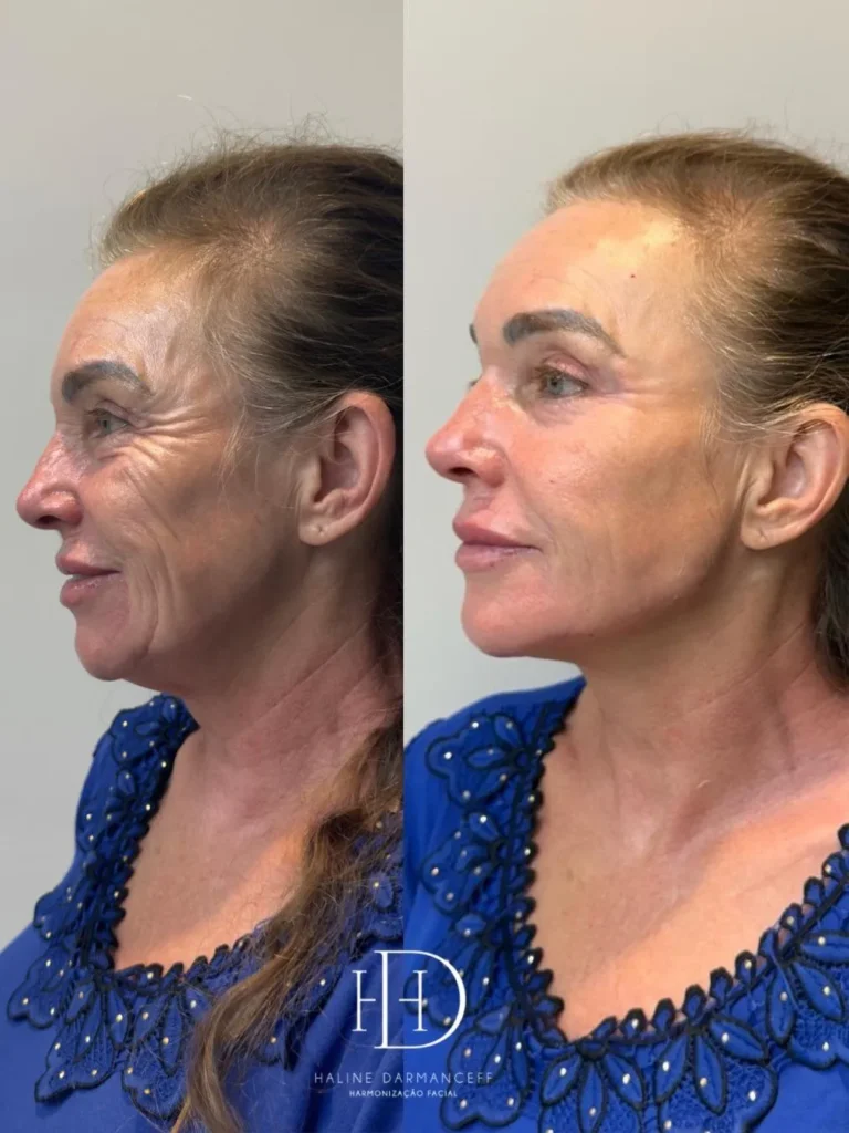 Com método próprio, Haline é referência em Harmonização Facial em Corumbá 5 haline1 haline