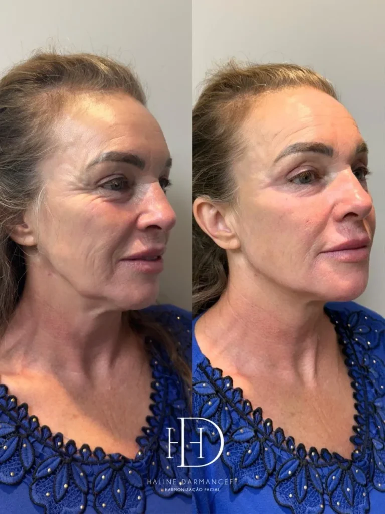 Com método próprio, Haline é referência em Harmonização Facial em Corumbá 6 haline2 haline