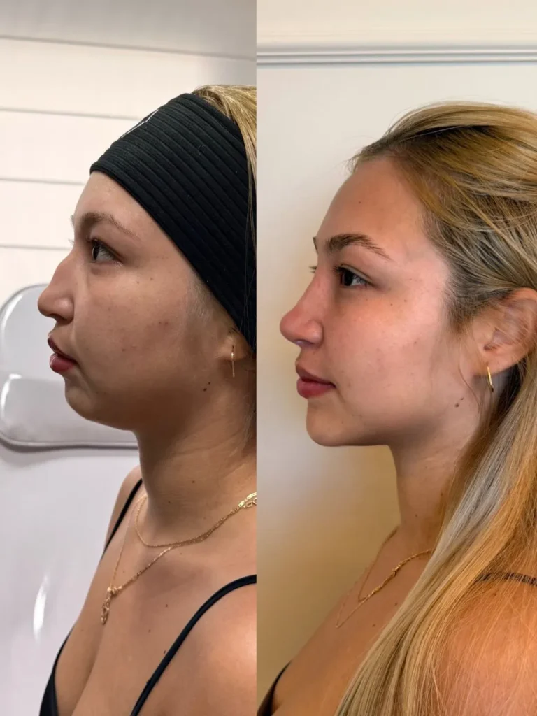 Com método próprio, Haline é referência em Harmonização Facial em Corumbá 7 haline5 haline