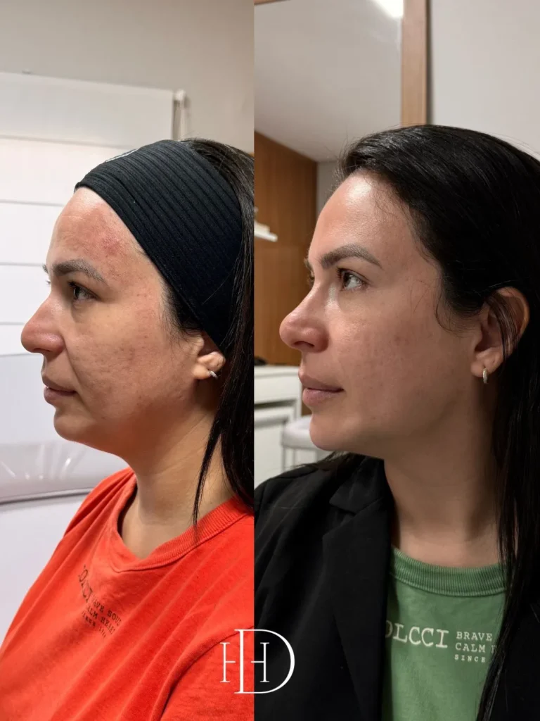 Com método próprio, Haline é referência em Harmonização Facial em Corumbá 8 haline6 haline