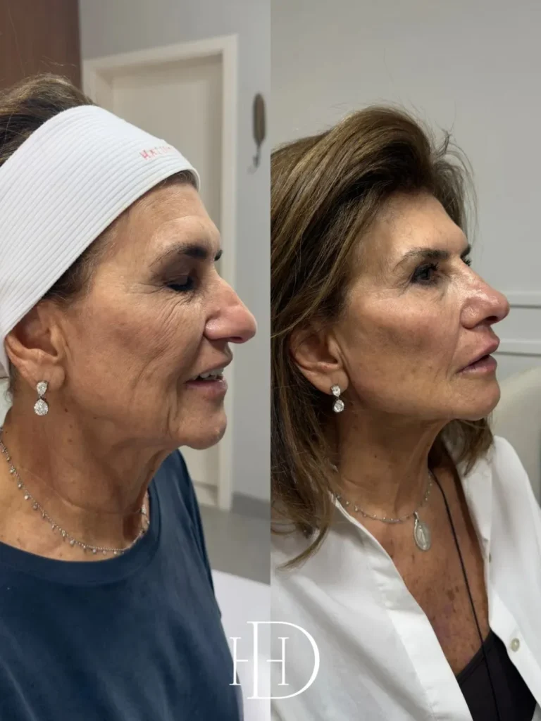 Com método próprio, Haline é referência em Harmonização Facial em Corumbá 9 haline7 haline