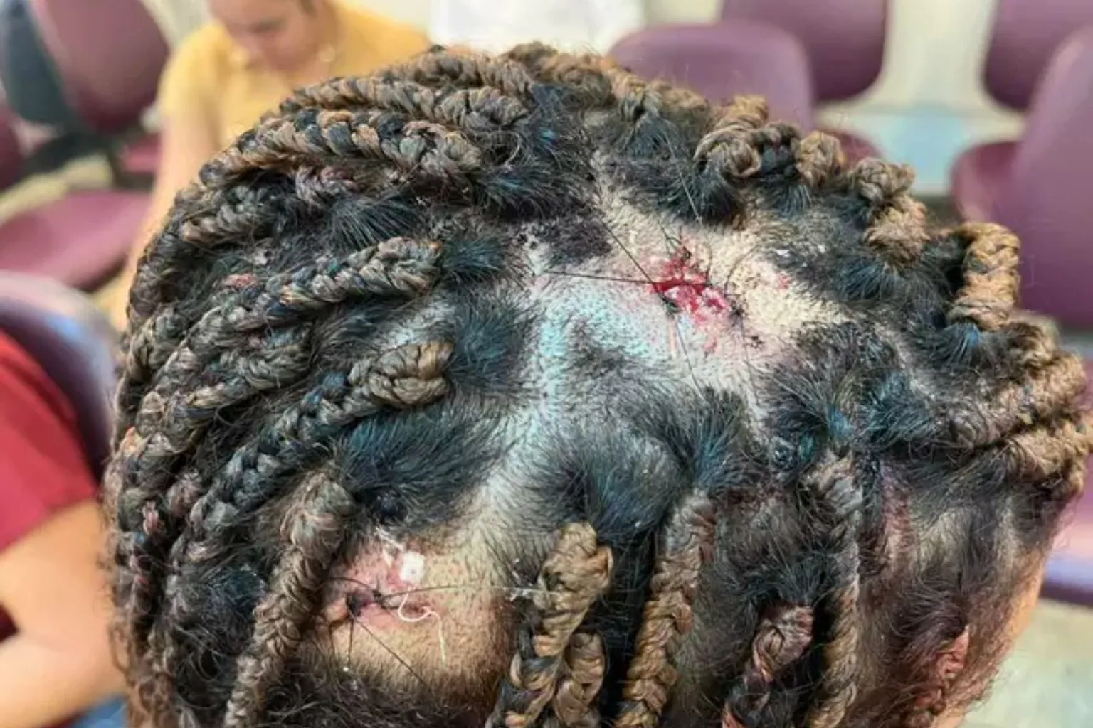 Adolescente de 17 anos foi agredida com marteladas na cabeça pelo namorado em Campo Grande. Vítima precisou de pontos e registrou boletim de ocorrência.