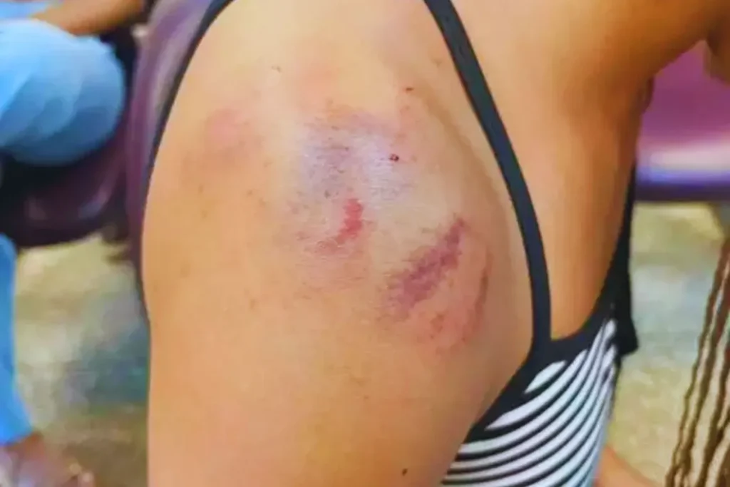 Adolescente de 17 anos foi agredida com marteladas na cabeça pelo namorado em Campo Grande. Vítima precisou de pontos e registrou boletim de ocorrência.