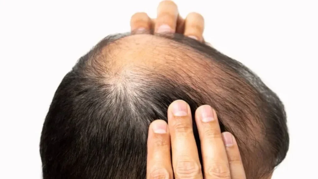 calvicie2 fim da calvície