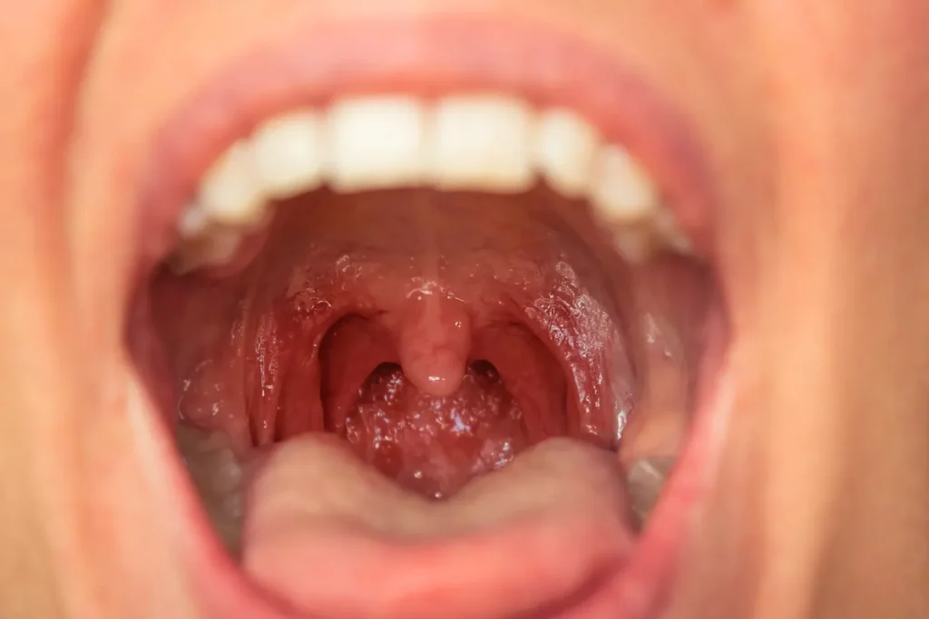 Biossensor identifica metástase do câncer de boca a partir da saliva 2 cancer câncer de boca