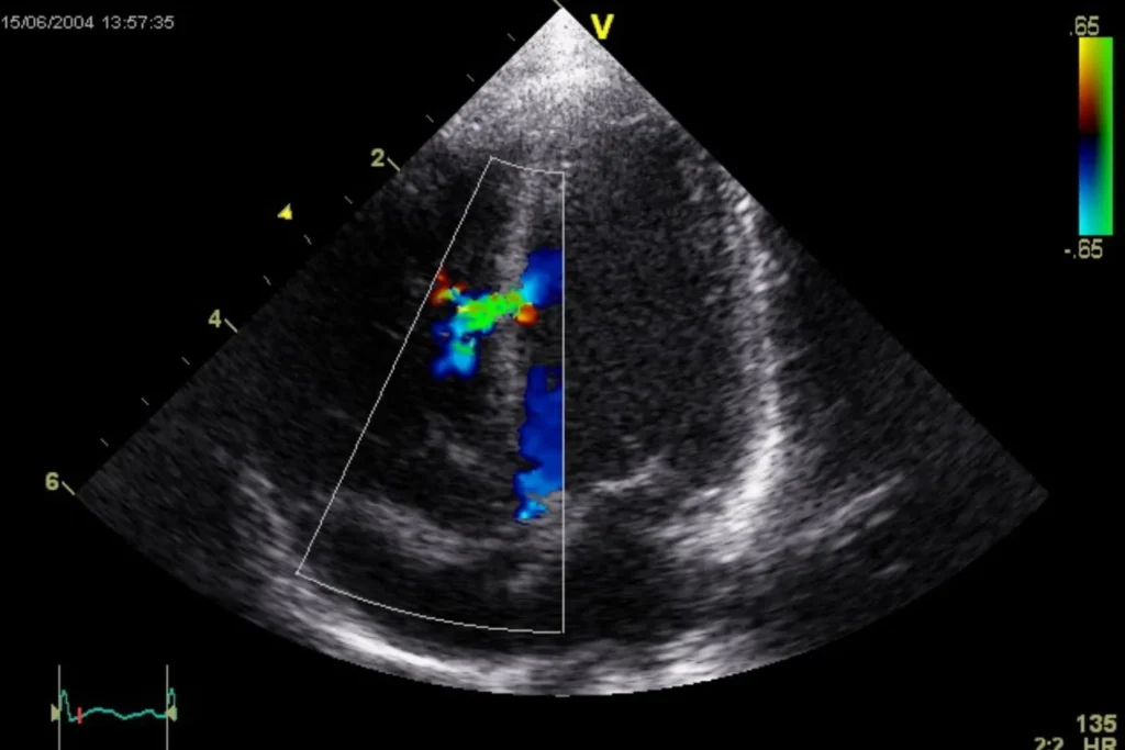 Novo exame de imagem acessível, o GLS, antecipa riscos de complicações e óbito na doença de Chagas. Entenda como funciona e suas vantagens.