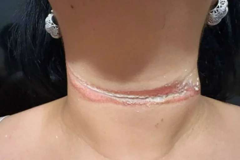 Professora de Três Lagoas quase foi enforcada por fio solto de internet ao andar de bicicleta. O acidente deixou cicatrizes e alerta para riscos na cidade.