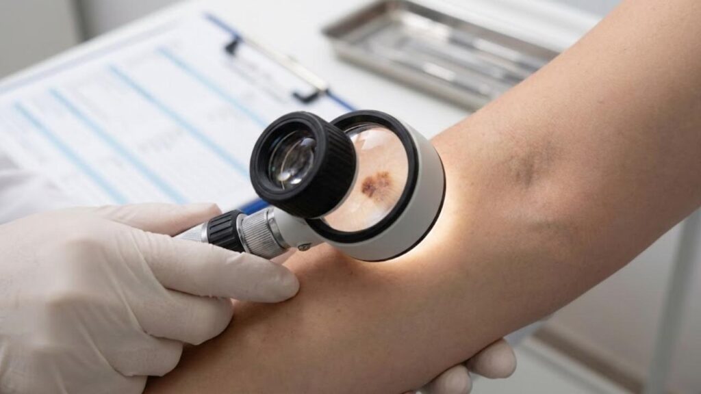 Saiba como proteger sua pele no verão e evitar o câncer de pele. Veja dicas de especialistas para prevenção e detecção precoce. Cuide da sua saúde.