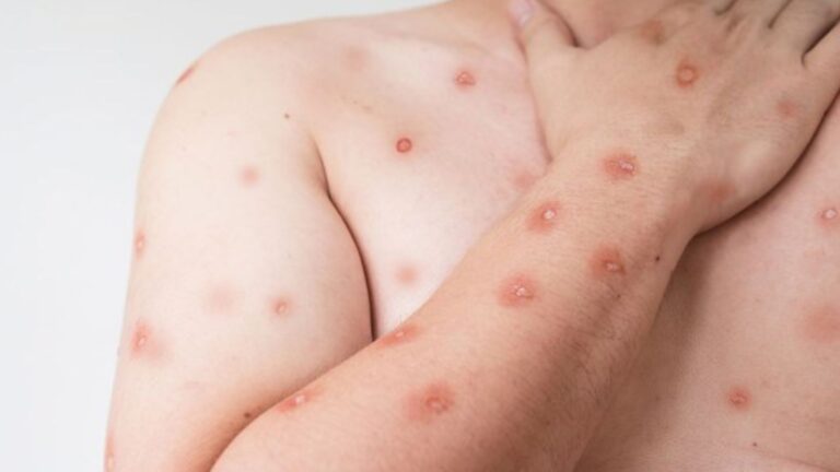Profissional de saúde examinando lesões na pele, com microscópio ao fundo, simbolizando diagnóstico de mpox.