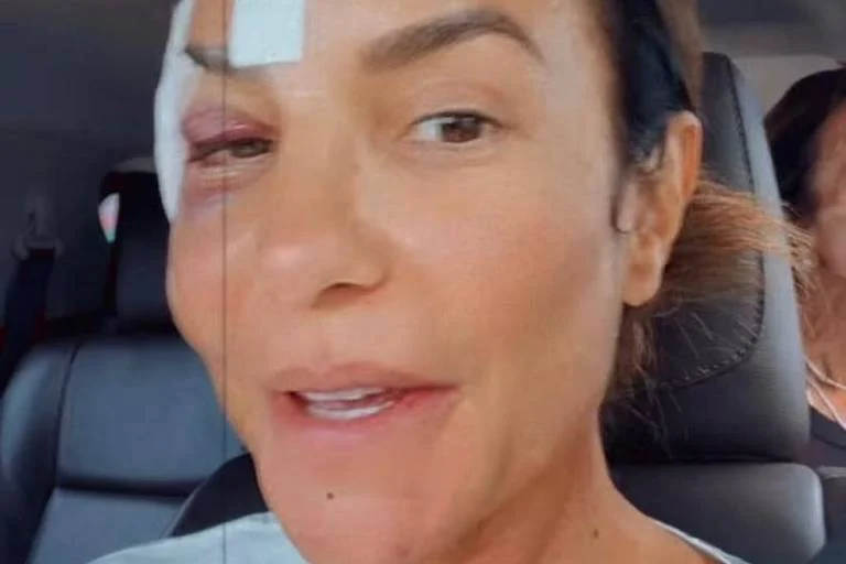 Ivete Sangalo recebe alta hospitalar após desmaiar e machucar o rosto em salvador