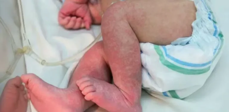 Imagem de conscientização sobre a epidemia de chikungunya em Mato Grosso do Sul, destacando a vulnerabilidade infantil.