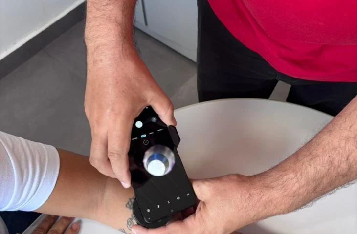 Telediagnóstico em dermatologia registra detecção precoce de câncer de pele em MS
