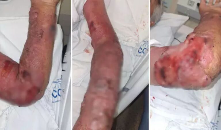 Pedreiro processa prefeitura e Estado após lesão grave em braço por erro médico em MS