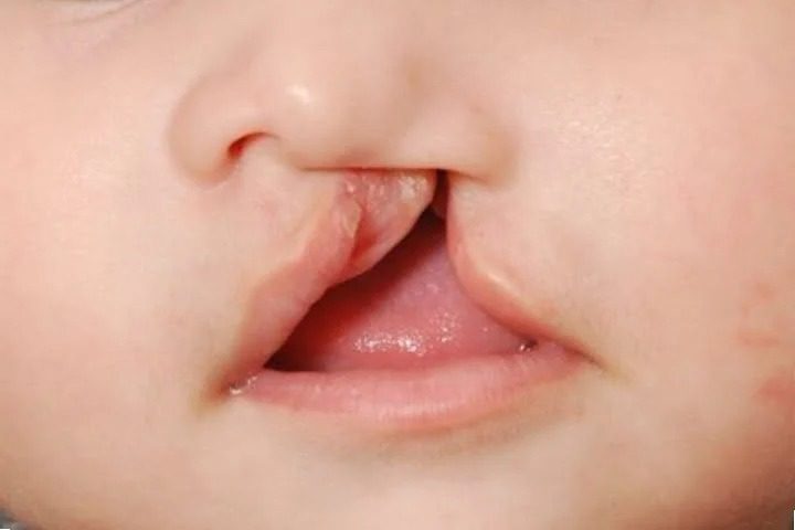 MS reconhece pessoas com fissura labiopalatina como pessoas com deficiência