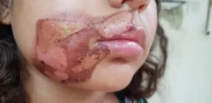 Leia mais sobre o artigo Em Pernambuco, criança tem rosto queimado pela mãe por não conseguir fazer tarefa da Escola