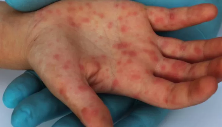 Leia mais sobre o artigo Estado já tem 42 casos de sarampo em investigação, três deles em bebês