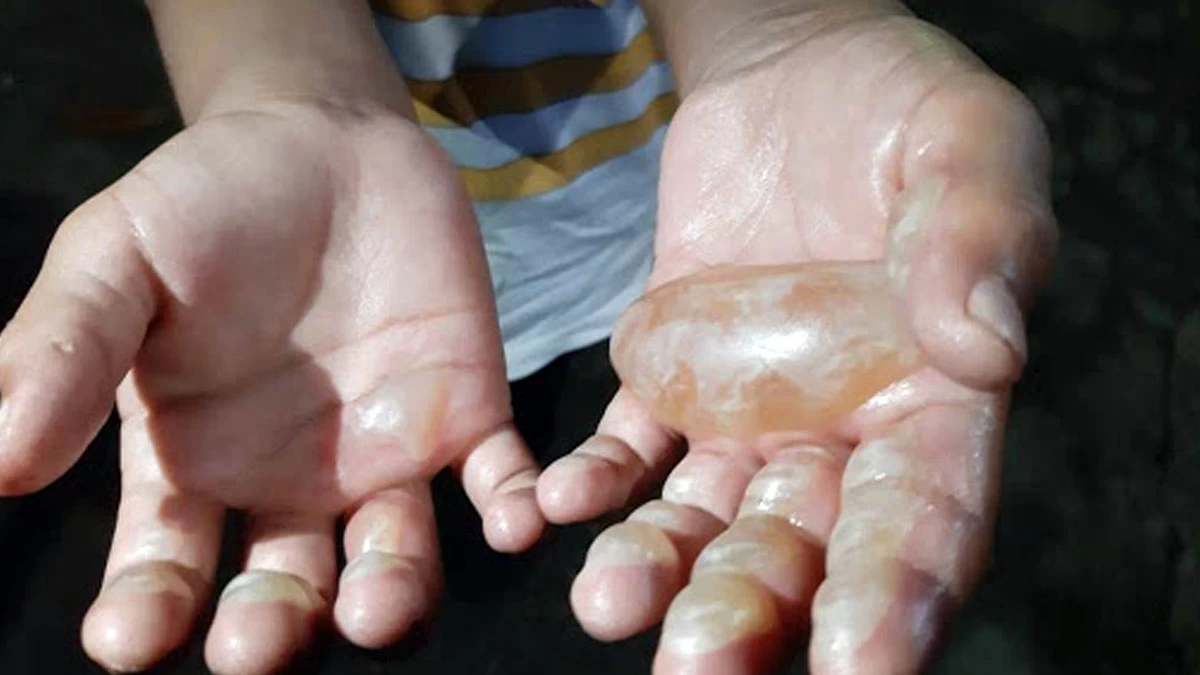 No momento, você está visualizando Menino de 6 anos tem mão queimada por mãe porque pegou dinheiro para levar à escola