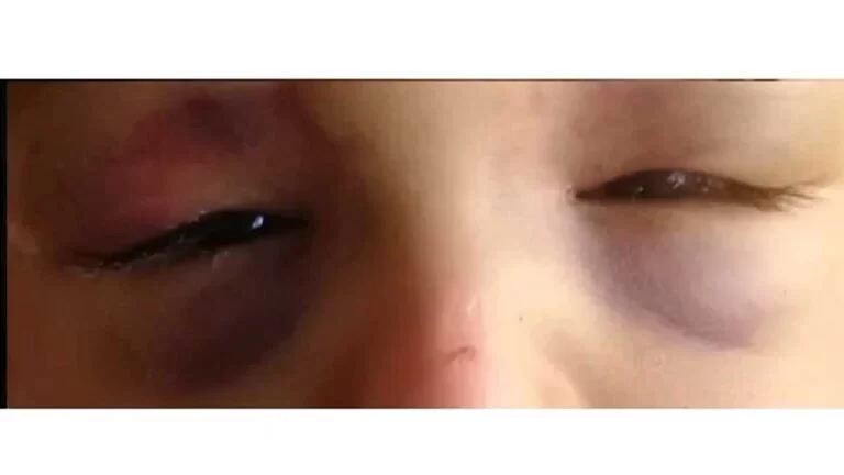 Pai denúncia ex depois de encontrar bebê de 2 anos com os olhos roxos