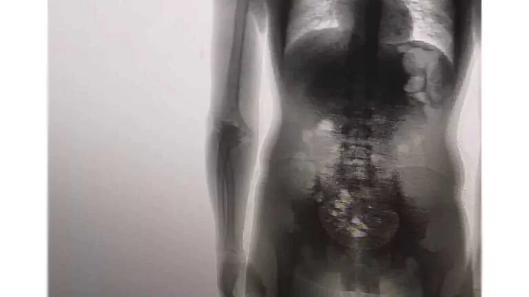 Preso é flagrado com 8 celulares, carregadores, cabos e chips dentro no corpo em MT