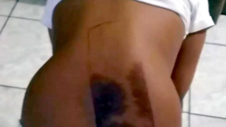 Criança sofre queimadura nas costas após dormir sobre celular