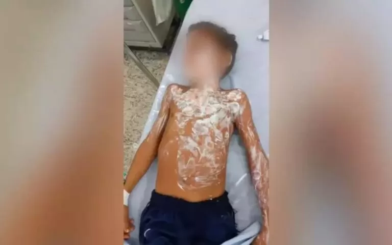 Criança sofre queimaduras graves após ser deixado sozinho por avó bêbada em MS