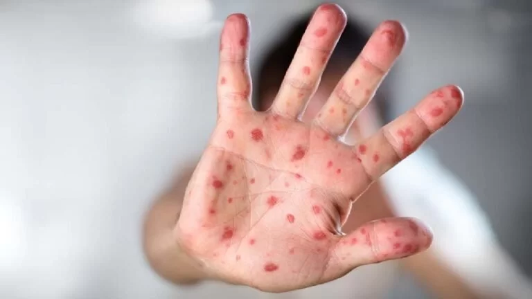 MS registra surto de doença ‘mão-pé-boca’ em crianças