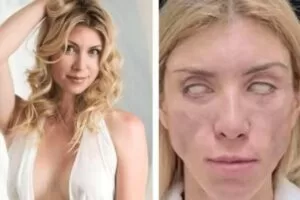 Leia mais sobre o artigo Miss russa afirma não conseguir fechar os olhos após cirurgia de R$17 mil