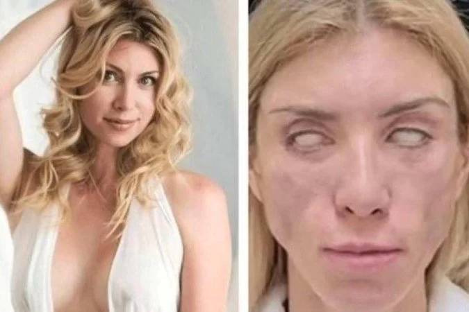 Você está visualizando atualmente Miss russa afirma não conseguir fechar os olhos após cirurgia de R$17 mil