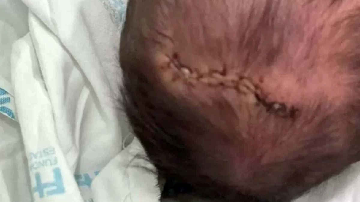 Leia mais sobre o artigo Recém-nascida sofre traumatismo craniano após queda em parto em Minas Gerais